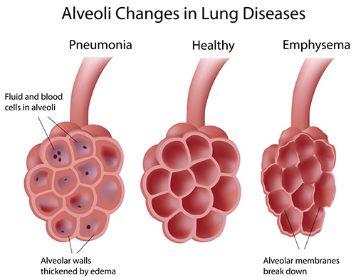 Respiratory System Diseases
